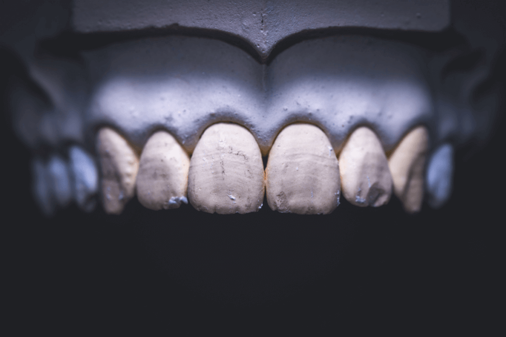 Conheça os tipos de gesso na odontologia 